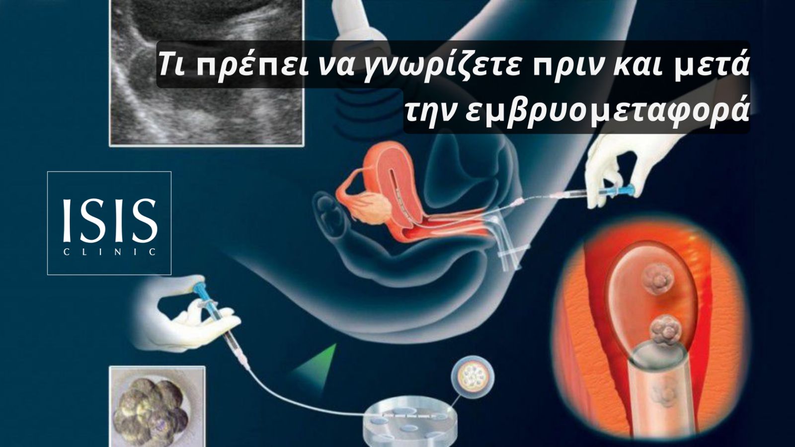 ivf-embryo-transfer-cyprus